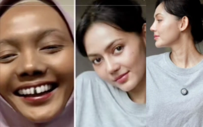 Tompi Pamer Hasil Oplas Rina Nose, Netizen Tercengang!