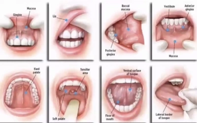 Mengenal Kanker Mulut, Penyakit yang Diderita Istri Pesulap Merah hingga Meninggal, Ini Sebabnya