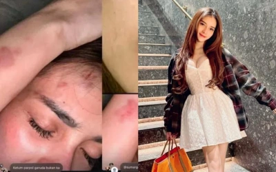 Nabilla Aprillya Diduga Dianiaya, Unggah Foto Lebam di Wajah hingga Ancaman Pembunuhan