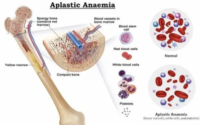 Mengenal Anemia Aplastik, Penyakit Penyebab Istri Pesulap Merah Meninggal Dunia, Ini Cara Obati