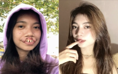 Inspiratif! Kondisi Rista Juniarti Bibir Sumbing Setelah Dioperasi dr Tompi