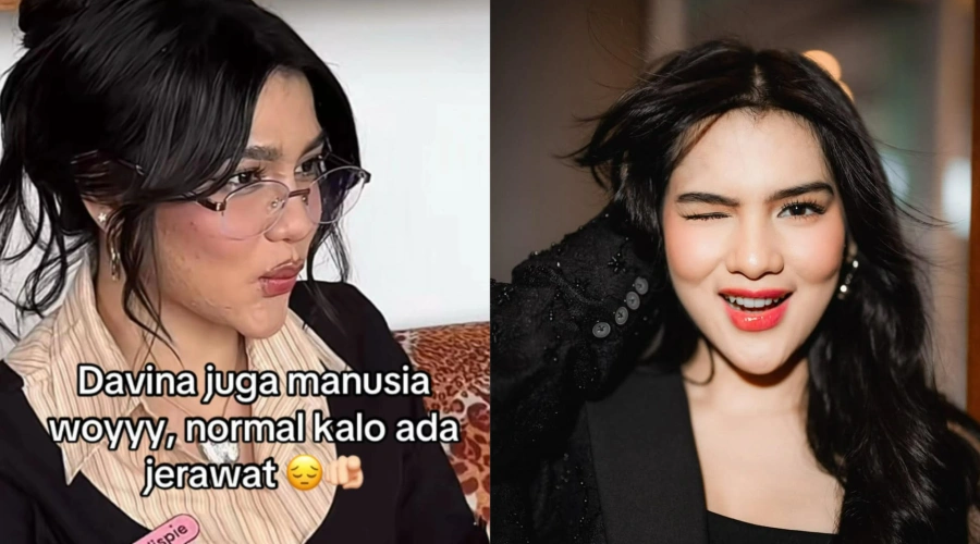 Respons Davina Karamoy Saat Wajah Berjerawatnya Dikaitkan dengan Ain