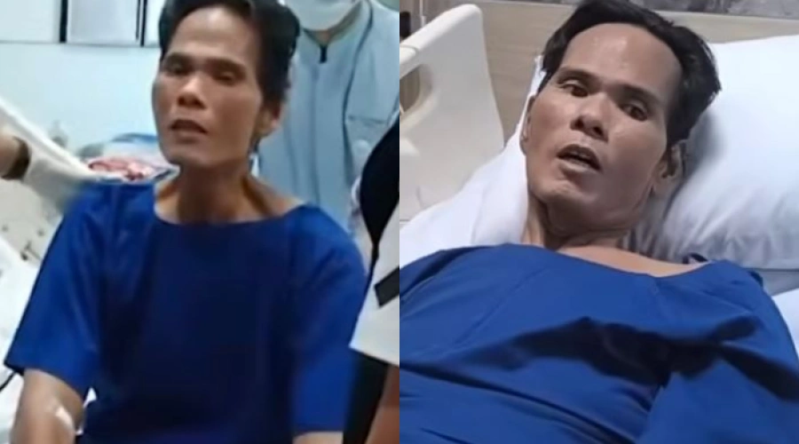 Fahmi Bo Jalani Operasi Batu Empedu, Wajahnya Kini Jadi Sorotan!