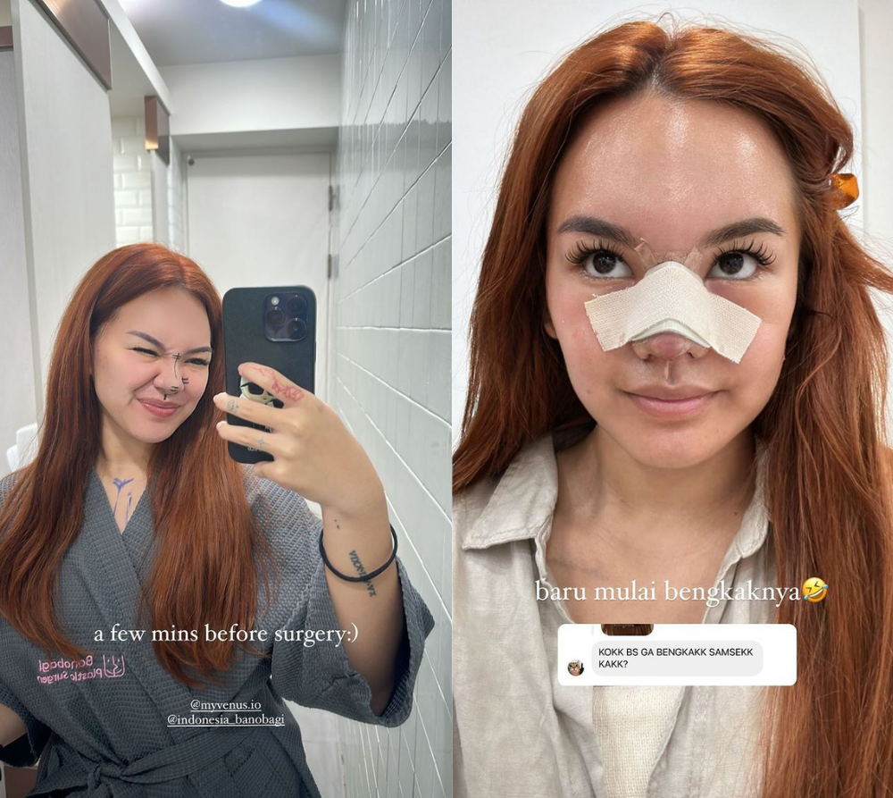Shafa Harris Oplas Hidung, Gunakan Tulang dari Iga