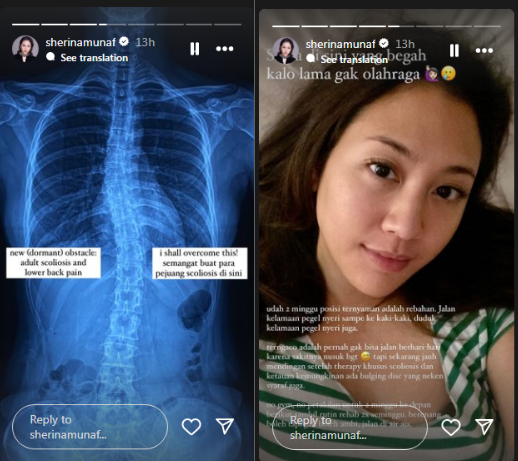 Sherina Munaf Jalani Terapi Skoliosis, Curhat Dua Minggu Posisi Terenak Cuma Rebahan