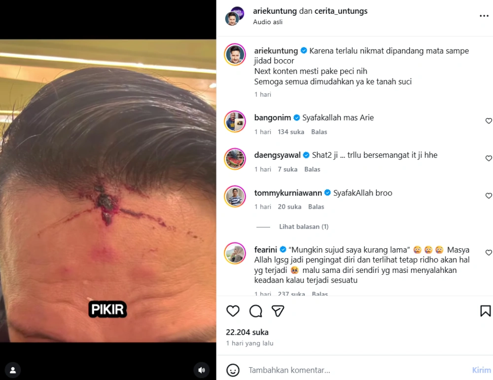 Arie Untung Alami Insiden Kepala Bocor Saat Umrah [sumber: Instagram Ariekuntung]