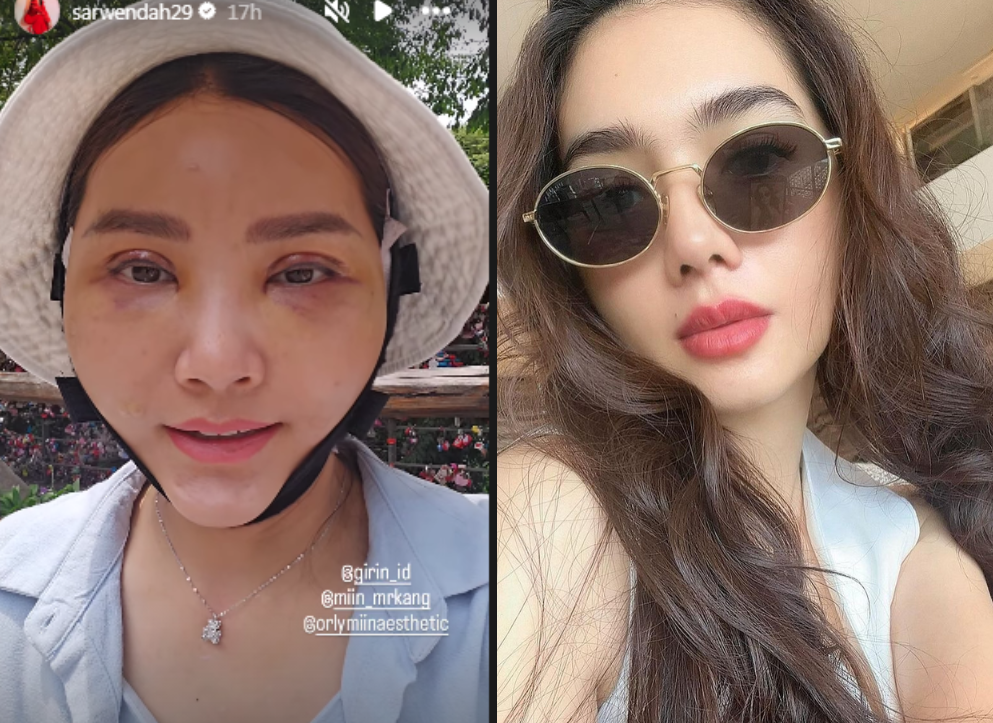 Sarwendah Oplas di Korea, 4 Artis Indonesia Operasi di Sana Hasilnya Makin Bening
