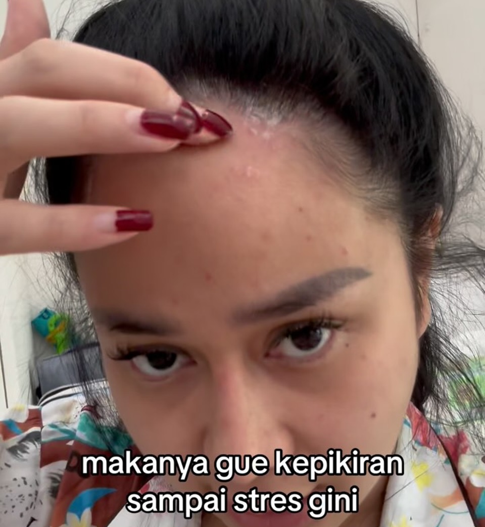 Autoimun Denise Chariesta Kambuh Gara-gara Stres [Instagram]