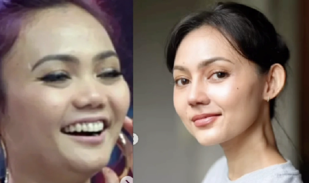 Hasil Operasi Plastik Rina Nose. [Instagram/dr Tompi]