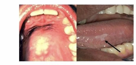 Kanker Mulut Dari Sariawan [Instagram]