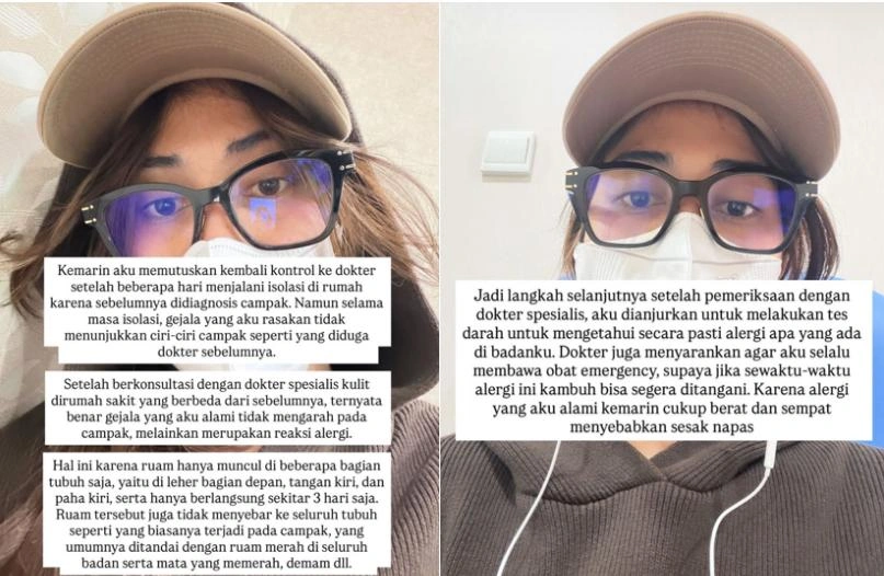 Klarifikasi Ruce Nuenda Soal Penyakit Campaknya Instagram