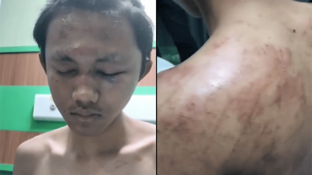 Kondisi Arnendo Mahasiswa Undip Semarang Korban Bullying [Sumber: X]