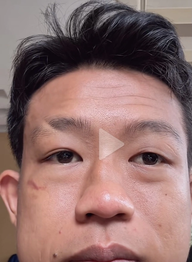 Kondisi Wajah Paris Pernandes Usai Dihajar Rudy Golden Boy (Tiktok)