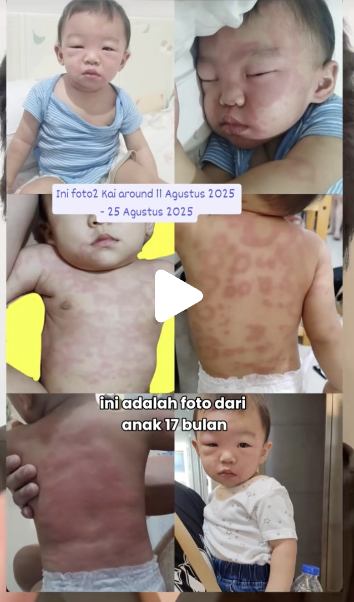 Bayi diduga alergi karena konsumsi roti repack