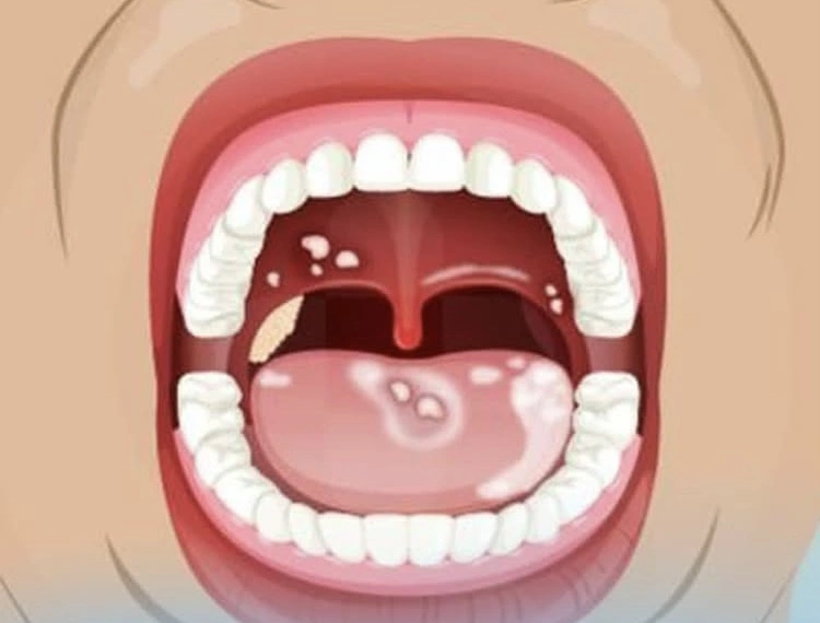 Mengenal Gejala Kanker Mulut [Instagram]