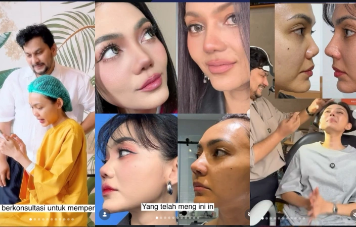 Perubahan Bentuk Hidung Rina Nose [Sumber: Instagram]