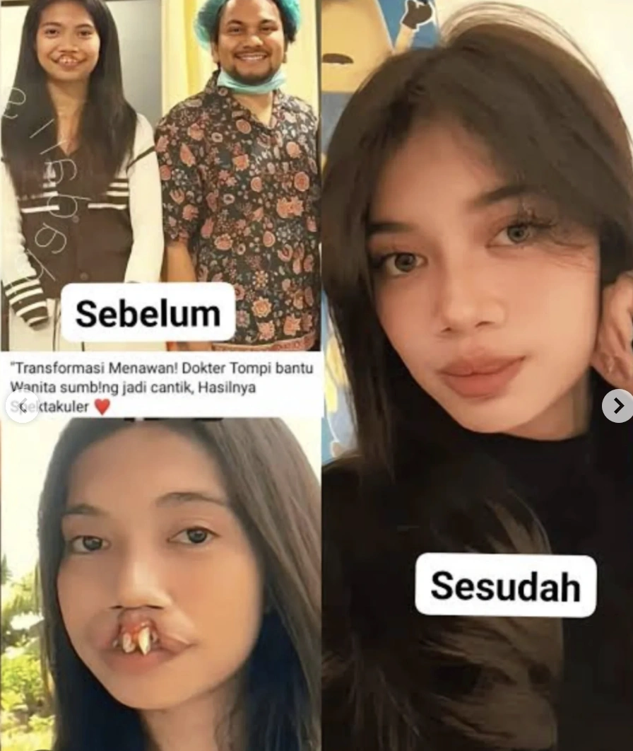 Rista Junianti sebelum dan sesudah operasi oleh dr Tompi. [Instagram]