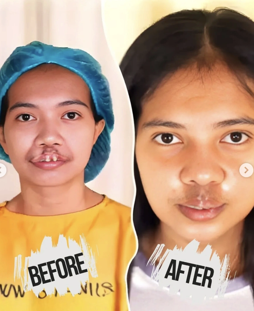 Rista Junianti sebelum operasi oleh dr Tompi. [Instagram]