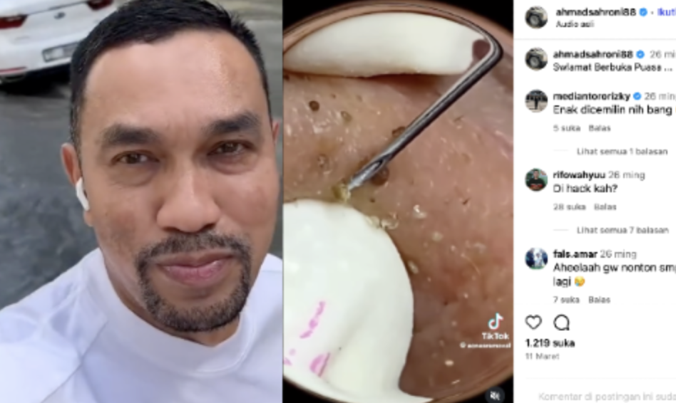 Ahmad Sahroni Gemar Pamer Video Mengeluarkan Jerawat dan Komedo, Ini Pandangan Psikologisnya!