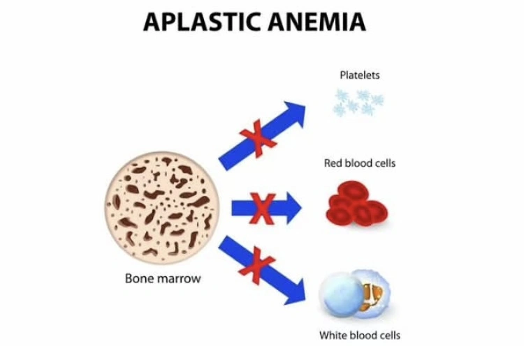 Sel Darah Penderita Anemia Aplastik [Instagram]