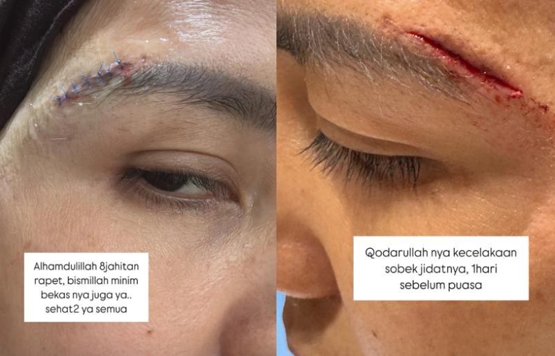 Tya Ariestya Dapat 8 Jahitan Instagram