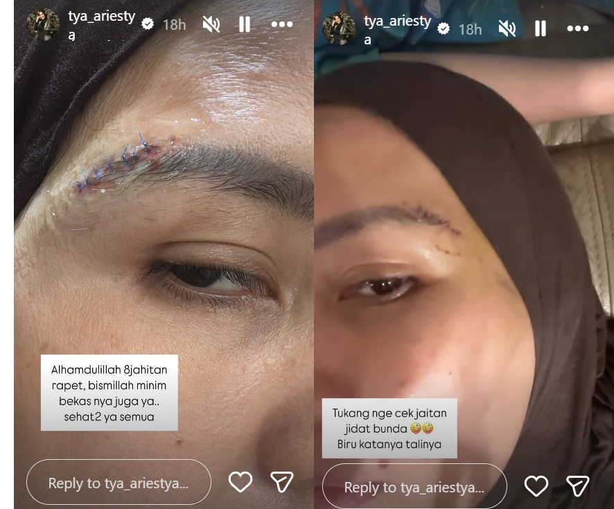 Tya Ariestya terluka hingga harus terima jahitan. (Instagram)