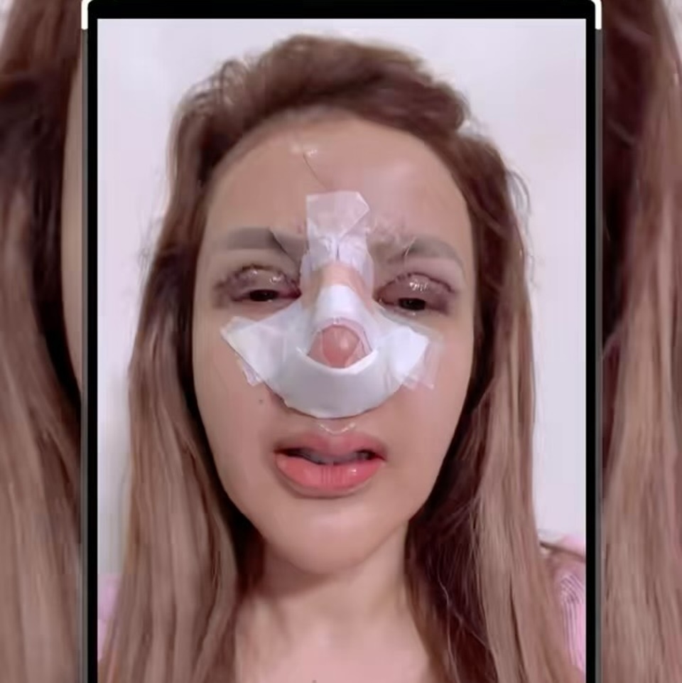Barbie Kumalasari Oplas Hidung & Kelopak Mata [Instagram]