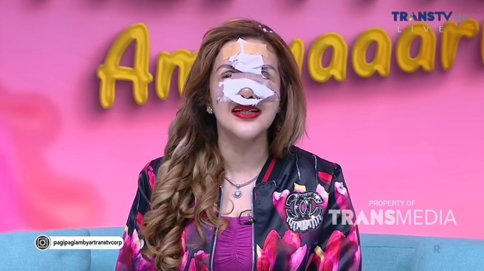 Barbie Kumalasari Oplas Hidung & Kelopak Mata [Instagram]