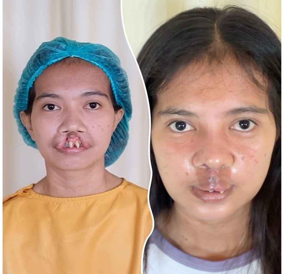 dr. Tompi Bantu OP Gadis Bibir Sumbing Bersuara Merdu [Instagram]